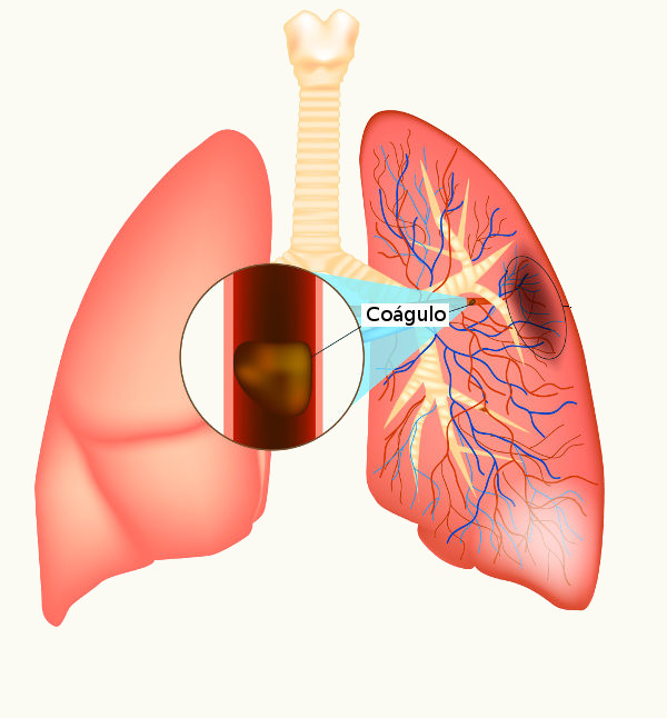 Embolia Pulmonar Alunos Online