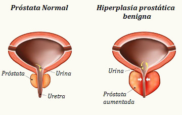 Observe como o aumento da próstata interfere no fluxo de urina