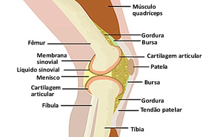 A bursite é causada por uma inflamação na bursa