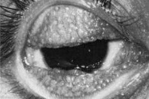 Tracoma: doença causada pela <i>Chlamydia trachomatis</i>.