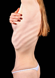 A anorexia pode provocar graves problemas físicos e mentais