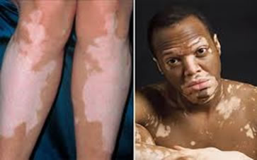 O vitiligo é uma doença não contagiosa que pode atingir pessoas de qualquer idade, sexo ou raça.