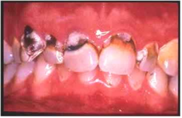 Escovação precária, falta de flúor em cremes dentais e na água, e falta de visitas ao dentista são os principais causadores das cáries.