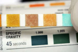 Médico segurando uma tira de teste de análise de urina e a gravidade específica do lado da ferramenta de diagnóstico