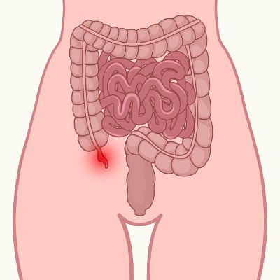 A apendicite é uma inflamação em uma estrutura chamada apêndice