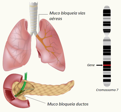 Na fibrose cística, observa-se a produção de um muco mais espesso que o normal