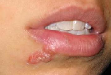 Lesões típicas do herpes labial.