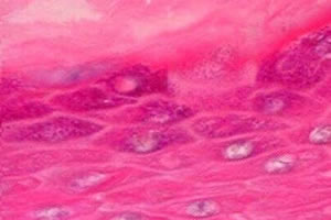 Epitélio estratificado pavimentoso queratinizado: células achatadas, dispostas em mais de uma camada e com queratina (camada superior).