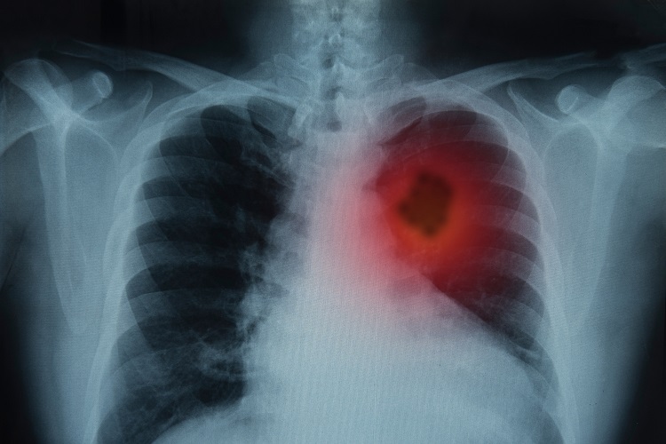 Todo tumor é um tipo de câncer?
